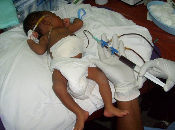 Diagram illustrating the exchange transfusion process